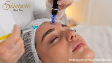 Advanced Potenza Microneedling Near Me for Youthful Skin