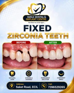 Get Fixed Zirconia Teeth in AS Rao Nagar & ECIL | Permanent Smile Makeover