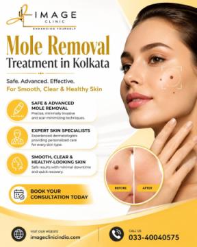 Professional Mole Removal Treatment in Kolkata | Trusted Skin Experts