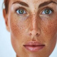 Sunspots Treatment Fort Collins Brighten and Even Skin Tone