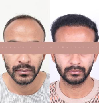 PRP Hair Treatment Indore – Best Hair Transplant Treatment in Indore for Natural Results