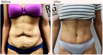 Tummy Tuck Surgery in Delhi - Dr Rajat Gupta