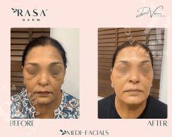 Hydrafacial Treatment in Delhi – Reveal Your Natural Glow