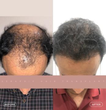 Best Hair Transplant in Indore – Expert Surgeons for Natural Hair Restoration