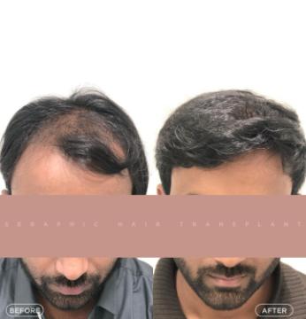 Best Hair Transplant in Indore – Expert Surgeons for Natural Hair Restoration