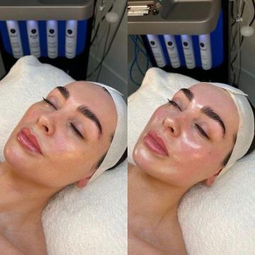 Hydrafacial Treatment in Thane at DNA Royal| Refresh Your Skin with Advanced Care