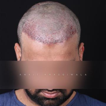 Hair Transplant in Indore | Advanced FUE Hair Restoration for Natural Results