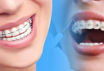 Orthodontic Treatment in Oshiwara
