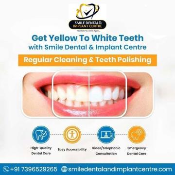 Affordable Teeth Cleaning in Hyderabad – Smile Dental and Implant Centre