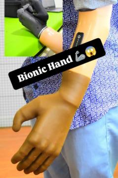 Free Artificial leg In Hyderabad | CareVale Prosthetics