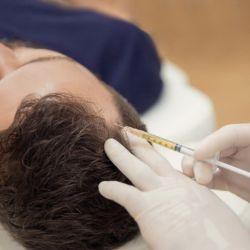 PRF Treatment for Hair Loss | Natural Hair Restoration Solution