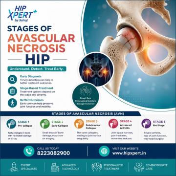 Stages of Avascular Necrosis Hip - HipXpert