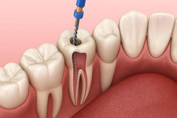 Best Invisalign Treatment | Affordable Invisalign Treatment in Madurai – Zaara Dentistr