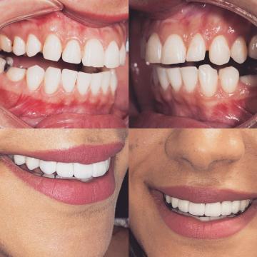 Affordable Dental Cleaning in Katy, TX | Open Saturdays | Charm Dental Katy
