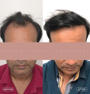 Hair Transplant in Indore | Trusted Experts for Natural Hair Restoration
