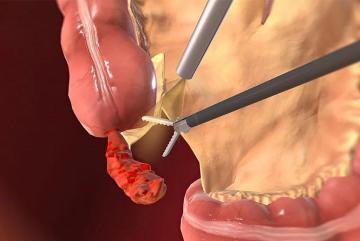 Top Appendix Doctor in Ahmedabad for Appendicitis Care