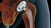 Reliable Total Hip Replacement Surgery in Pune