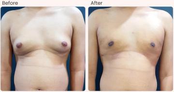 Gynecomastia Surgery Cost in Delhi - Dr Rajat Gupta