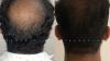 Best Hair Transplant in Indore – Expert Surgeons for Natural Hair Restoration