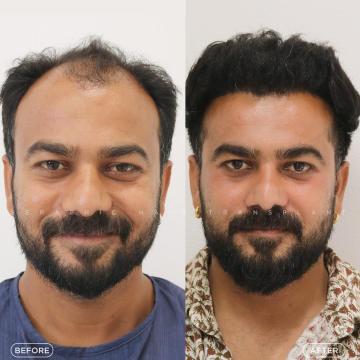 PRP Hair Treatment Indore – Best Hair Transplant Treatment in Indore for Natural Results