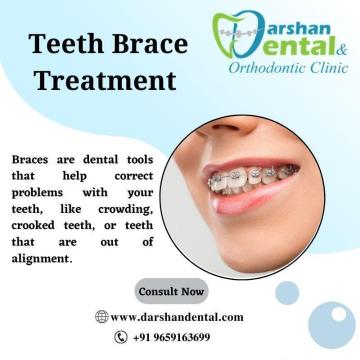 Best teeth braces treatment kanyakumari | Dental implant clinic in kanyakumari