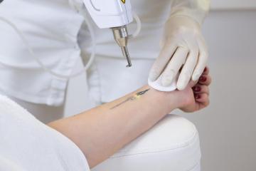 laser tattoo removal Pune