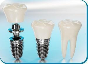 Best Dental Implant in Ahmedabad
