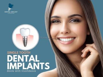 Grab offers and deals on tooth implants solution