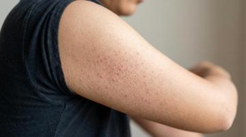 TryStrawberry’s Triple-Acid Complex Effective for Strawberry Skin