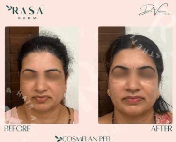 Rasaderm: Cosmelan Peel Price in Delhi