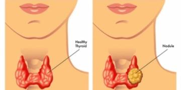 Thyroid Nodule Treatment Without Surgery in India – Safe Care