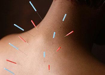 Acupuncture Etobicoke