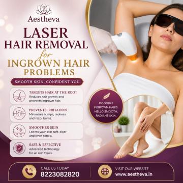Laser Hair Removal for Ingrown Hair Problems - Aestheva