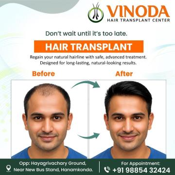 Best Hair Transplant Clinic in Hanamkonda