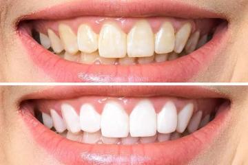 Professional Teeth Whitening & Cosmetic Dentistry in Miami