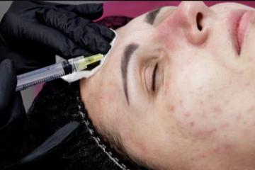 Best Doctor for Acne Treatment in Delhi
