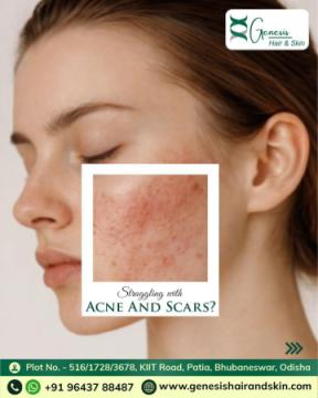 Acne treatment near me in Bhubaneswar