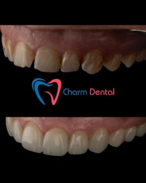 Professional Teeth Whitening in Tomball TX