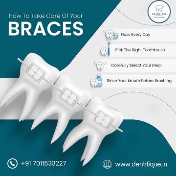 Affordable Braces Treatment in New Delhi - Dentifique Dental Clinic