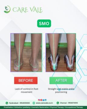 Best Artificial Leg in Hyderabad | CareVale Prosthetics