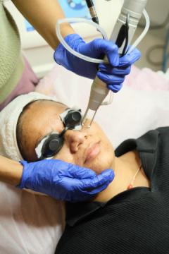 Chemical Peel Treatment for Acne Scars & Pigmentation – Koniki Luxe Hyderabad