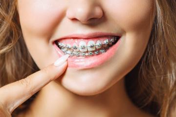 Orthodontic Treatment in Madhapur
