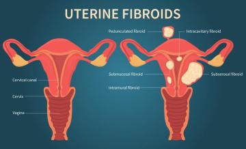 Complete Guide to Fibroid Prevention and Care