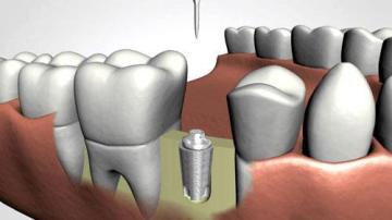 Emergency Dentist Flushing | Best Restorative dentistry Bayside
