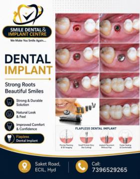 Missing Teeth? Restore Your Natural Smile with Dental Implants in ECIL & AS Rao Nagar