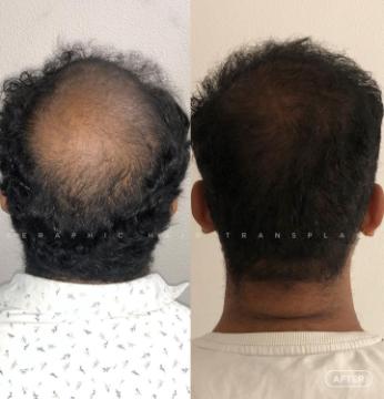 Hair Transplant in Indore | Trusted Experts for Natural Hair Restoration