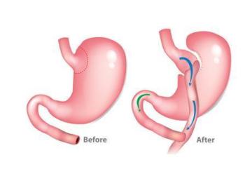 Bariatric Surgery in Coimbatore - Indian Bariatrics
