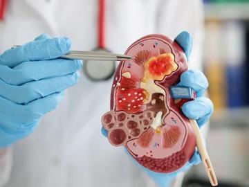Advanced Chronic Kidney Disease Care in Ahmedabad