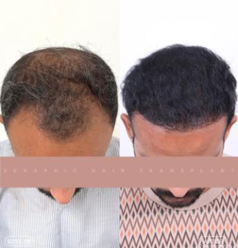 Hair Transplant in Indore | Trusted Experts for Natural Hair Restoration