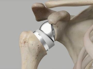 Shoulder Replacement Surgery in Ahmedabad